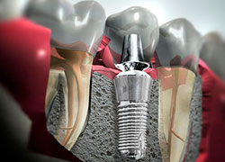 cirujanos maxilofaciales en quito Implantes Dentales Ecuador